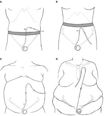 Optimizing peritoneal dialysis catheter placement